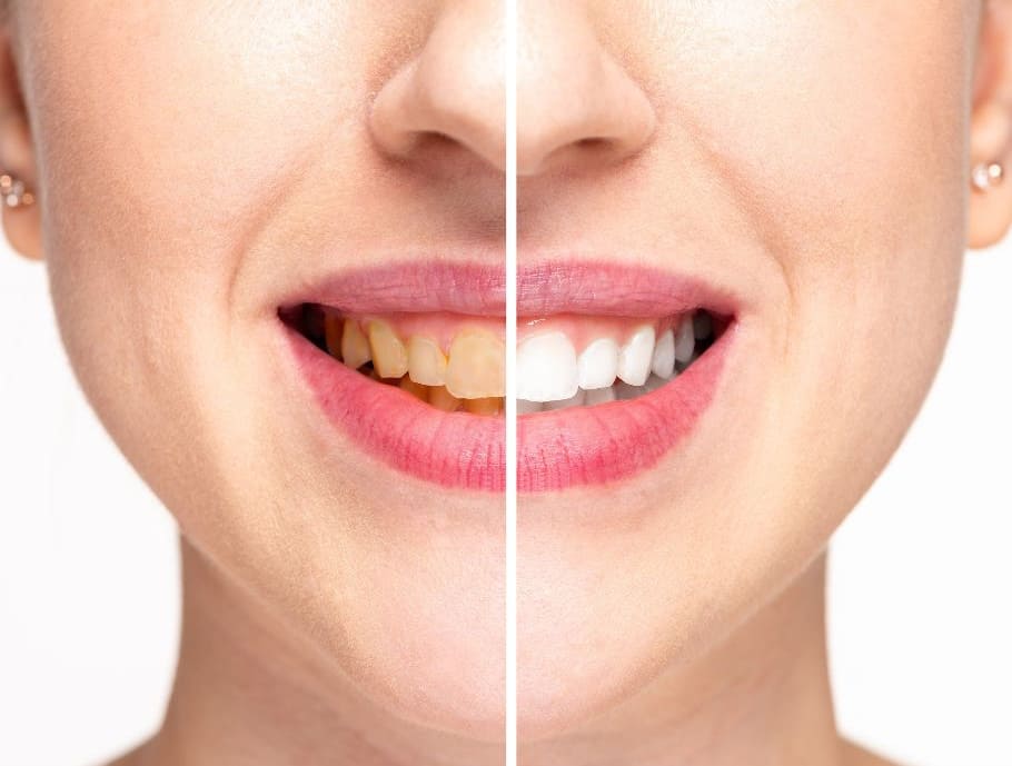 pulizia e sbiancamento dei denti differenze